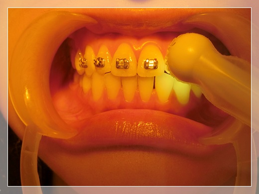 高雄,牙齒矯正,牙醫診所,牙科矯正,戴牙套,裝牙套,高雄牙齒矯正,牙科矯正費用,高雄裝牙套,牙齒矯正權威,牙齒矯正專科,高雄牙齒矯正診所推薦,高雄裝牙套診所推薦,高雄左營區牙醫矯正,牙醫診所,高雄牙醫權威,高雄牙科醫生,高雄牙齒矯正分期,高雄牙齒矯正牙醫師,高雄牙齒矯正推薦